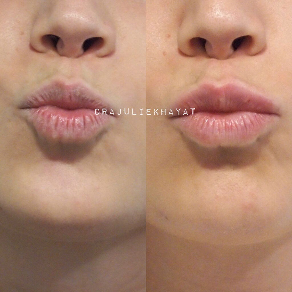 relleno labios doctora granada